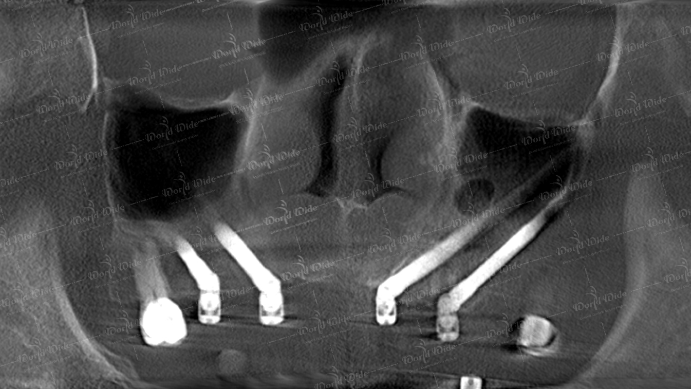 ZYGOMA IMPLANT Dental Center Vietnam