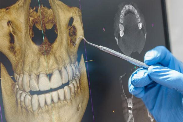 CBCT VS. X-RAYS
