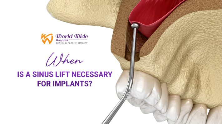 WHEN IS A SINUS LIFT NECESSARY FOR IMPLANTS?